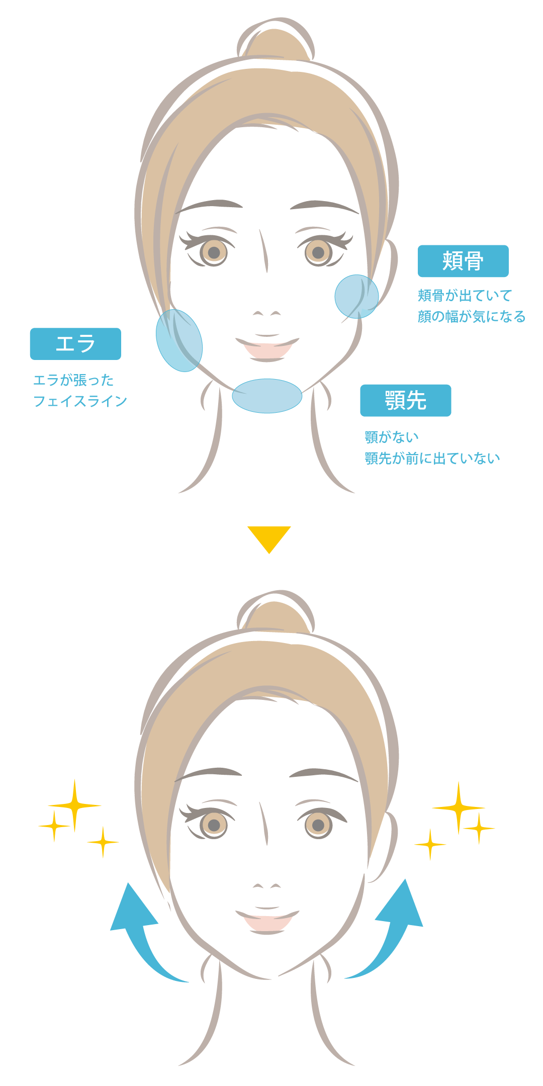 SINSANG整形外科の輪郭3点整形